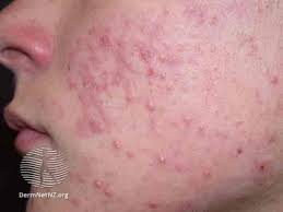 difference between acne and cyst