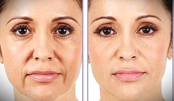 marionette lines botox before and after