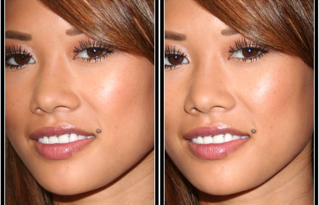 before and after hyaluronic lip fillers
