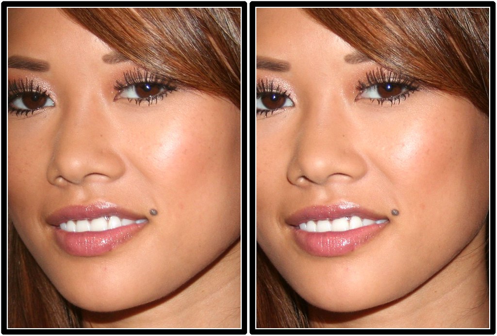 before and after hyaluronic lip fillers